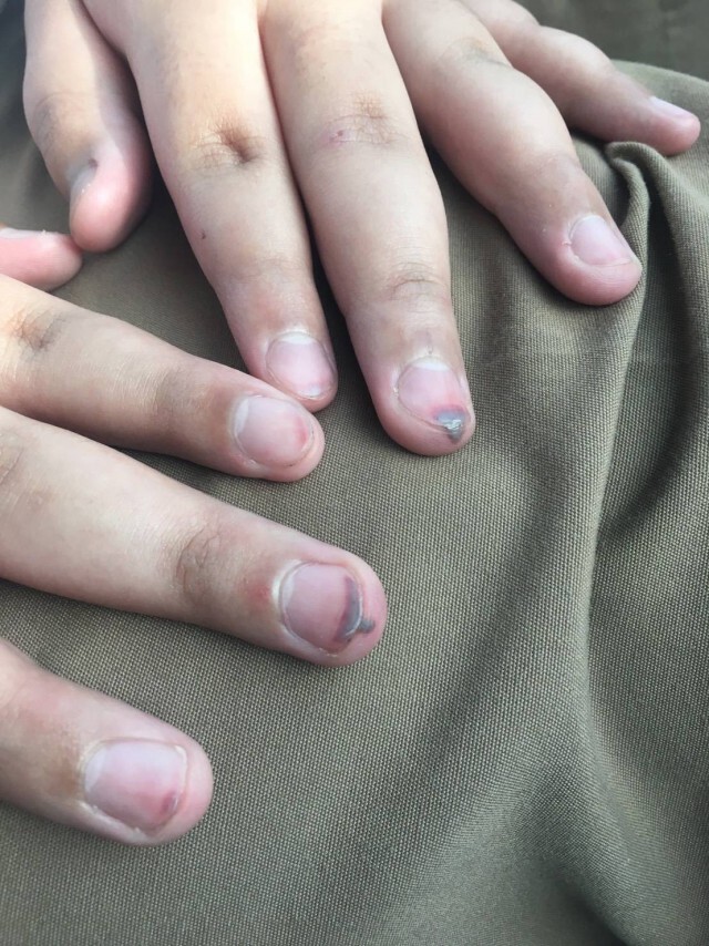 แม่รับไม่ได้ครูทำโทษลูกป.6 ใช้แปรงตีนิ้วห้อเลือด