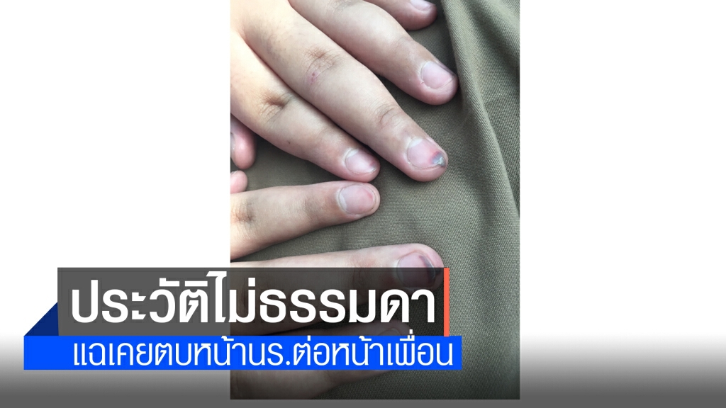 สพป.เขต 2 จี้ รร.เร่งสืบข้อเท็จจริงครูทำโทษ ป.6 นิ้วห้อเลือด