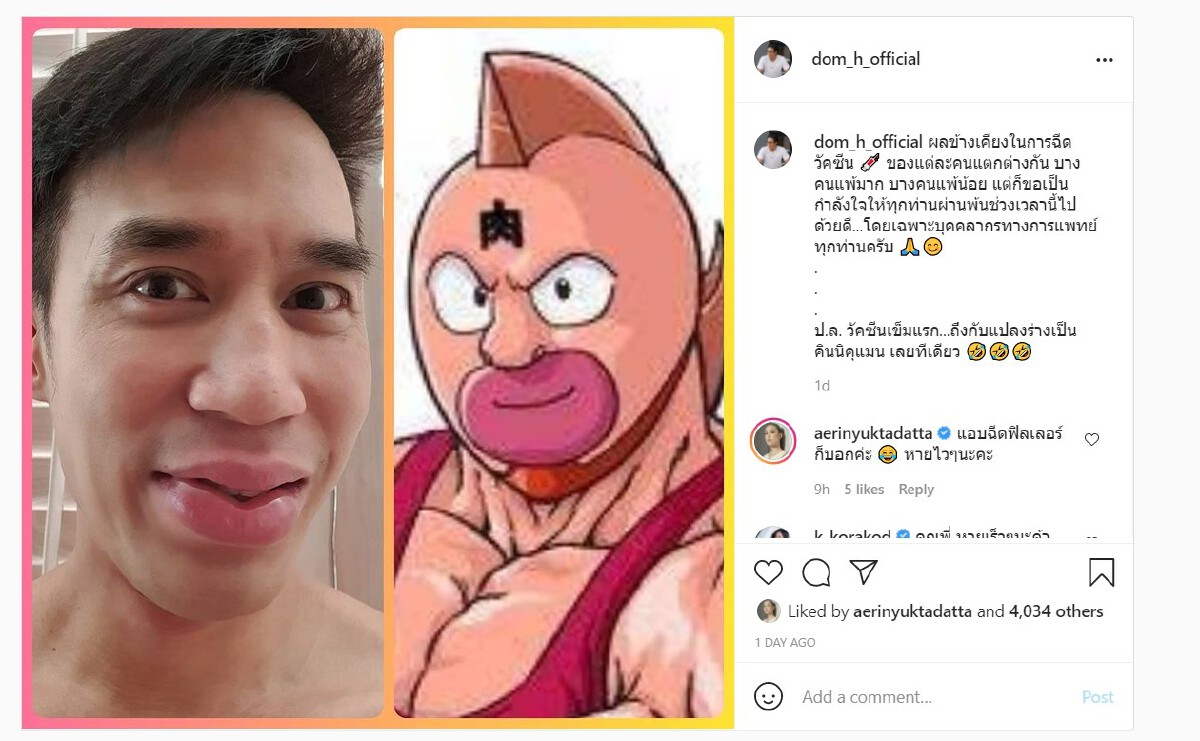 แฟนๆช็อก! "ดอม เหตระกูล" ปากบวมฉึ่งหลังฉีดวัคซีนโควิด