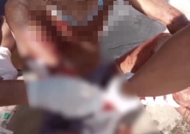 สุดสลด! สุนัขรุมขย้ำคุณตาอายุ 79 ปี เจ็บสาหัสถึงขั้นเสียแขน