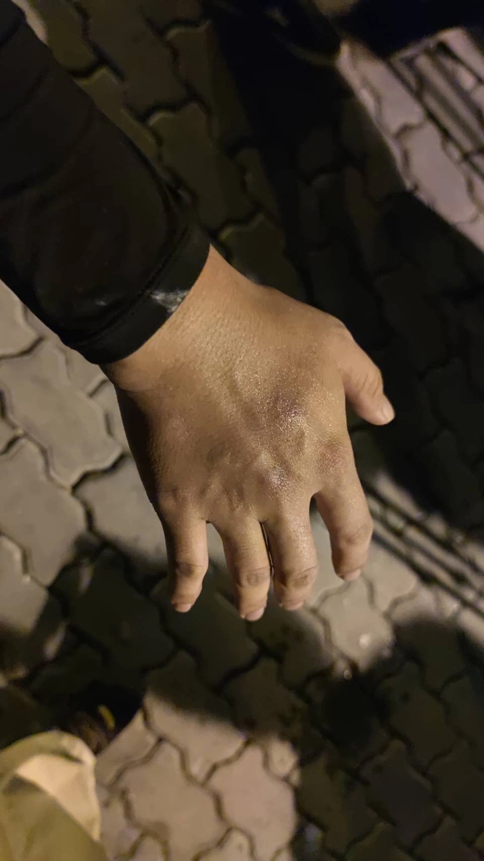 ผู้สื่อข่าวบาดเจ็บจากการถูกพลุของผู้ชุมนุม