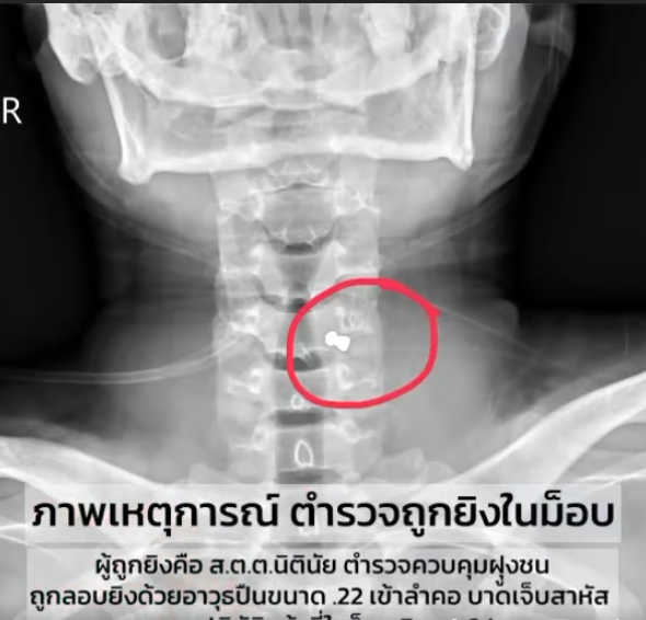 ภาพจากแผ่นฟิล์มเอกซ์เรย์ 