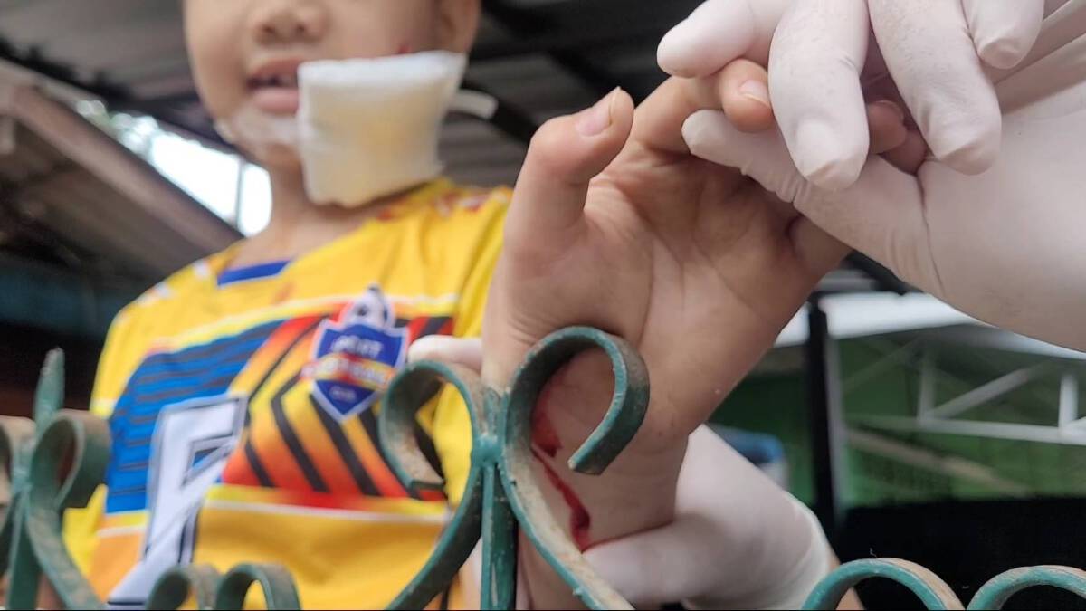เด็ก11ขวบซนไล่จับแมว-พลัดตกถูกเหล็กเสียบมือเจ็บ