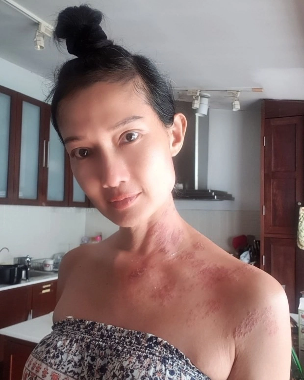 “ดี้ ชนานา” เผยชีวิตที่ต้องสู้กับ "โรคงูสวัด" พร้อมเตือนรุ่นใหญ่ให้ระวัง