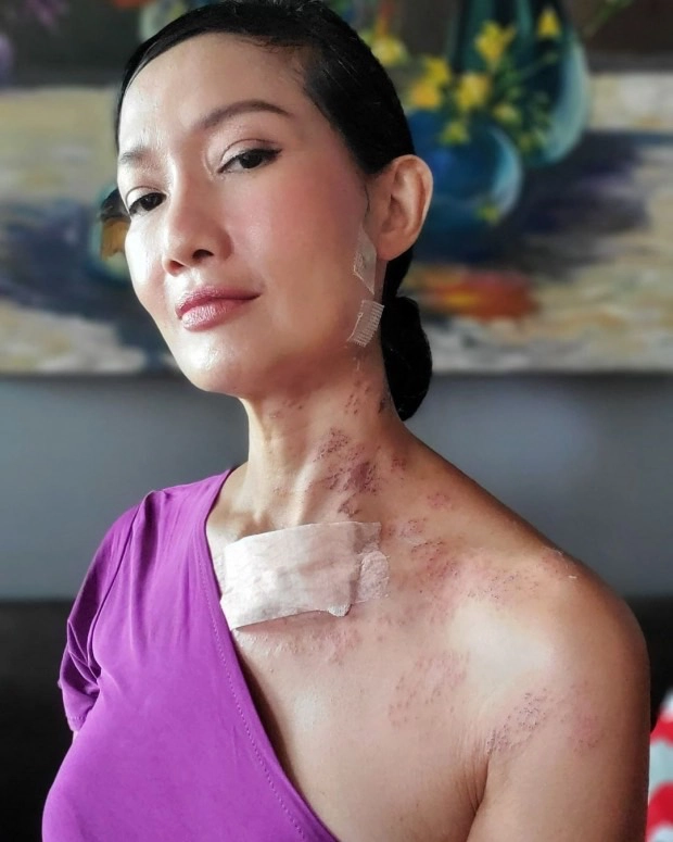 “ดี้ ชนานา” เผยชีวิตที่ต้องสู้กับ "โรคงูสวัด" พร้อมเตือนรุ่นใหญ่ให้ระวัง