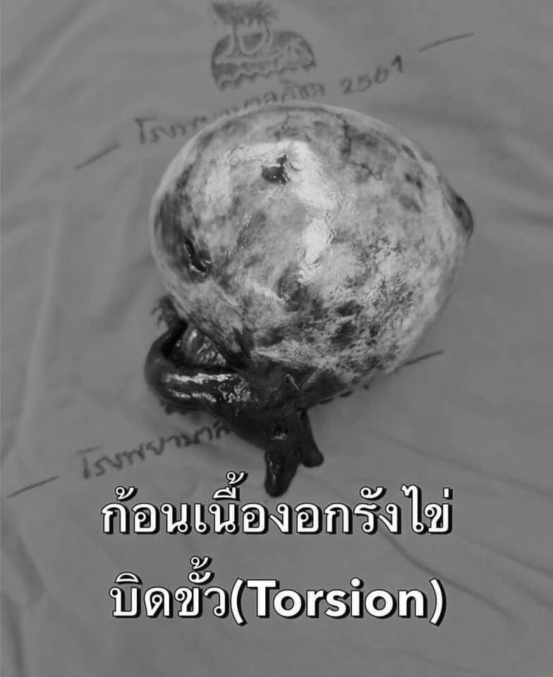 หมอแจงไม่ใช่คุณไสย! หลังผ่าเนื้องอกในท้อง เจอเส้นผม กระดูก เล็บ ฟัน