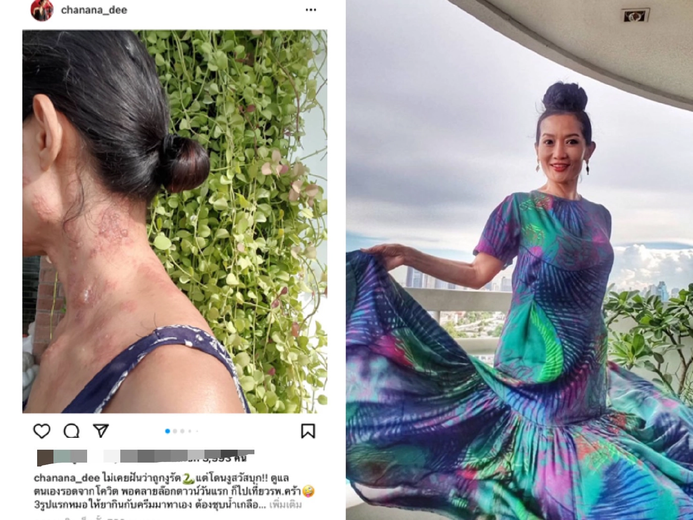 “ดี้ ชนานา” เผยชีวิตที่ต้องสู้กับ "โรคงูสวัด" พร้อมเตือนรุ่นใหญ่ให้ระวัง