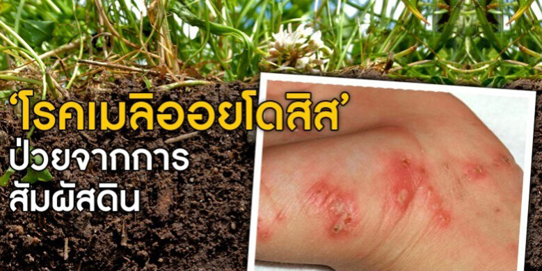 กรมควบคุมโรคเตือน ปชช.โดยเฉพาะเกษตรกร ระวังป่วยโรคเมลิออยโดสิส