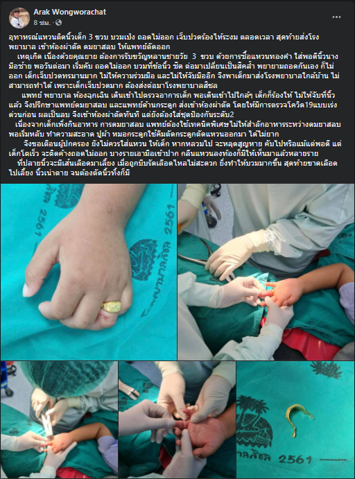 อุทาหรณ์! ยายรับขวัญหลาน 3 ขวบ ใส่แหวนทองให้สุดท้ายถอดไม่ออกต้องผ่าตัด