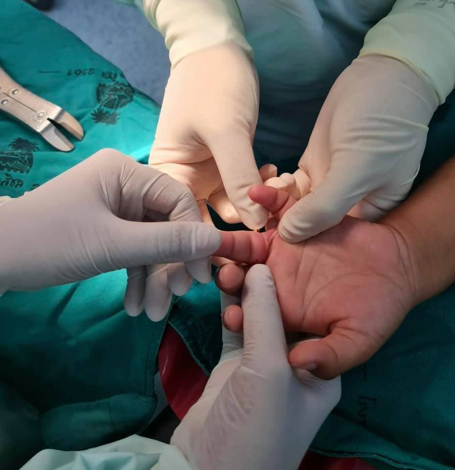 อุทาหรณ์! ยายรับขวัญหลาน 3 ขวบ ใส่แหวนทองให้สุดท้ายถอดไม่ออกต้องผ่าตัด