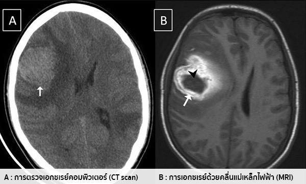 "มะเร็งสมอง" สัญญาณเตือน ภัยร้ายใกล้ตัว อันตรายถึงชีวิต