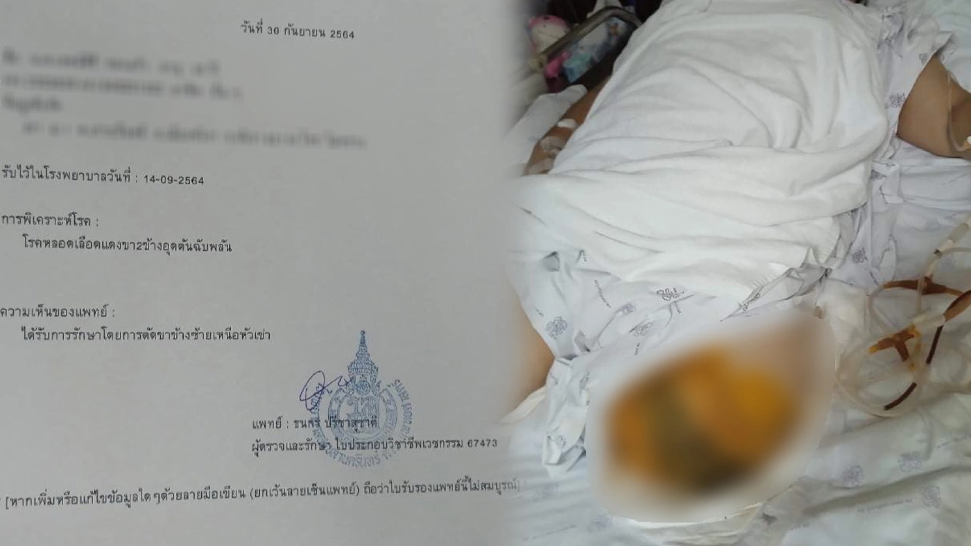 สปสช.จ่าย 4 แสน นศ.พังงา ถูกตัดขาหลังฉีดวัคซีนไขว้เข็ม 2