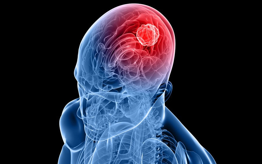 "มะเร็งสมอง" สัญญาณเตือน ภัยร้ายใกล้ตัว อันตรายถึงชีวิต