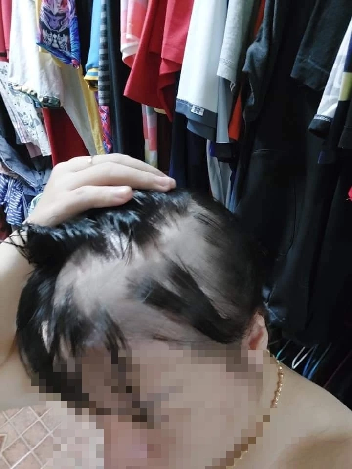 โผล่อีกเพียบ! ฉีดวัคซีนแล้วผมร่วง หวังหน่วยงานรัฐช่วยเหลือ