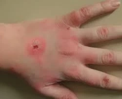 กรมควบคุมโรคเตือน หนาวนี้ระวัง "โรคสครับไทฟัส"