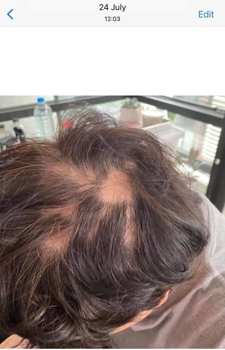 โผล่อีกเพียบ! ฉีดวัคซีนแล้วผมร่วง หวังหน่วยงานรัฐช่วยเหลือ