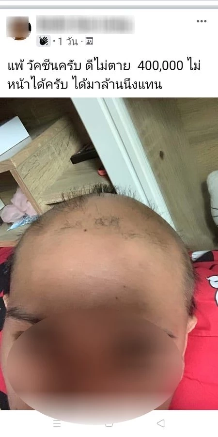 แชร์สนั่น! หนุ่มนักกีฬาฉีดวัคซีน "ซิโนแวค" เส้นผมร่วงเกือบหมดศีรษะ