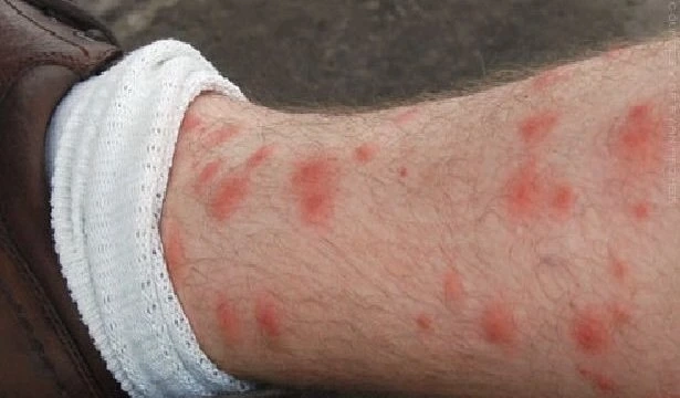 กรมควบคุมโรคเตือน หนาวนี้ระวัง "โรคสครับไทฟัส"