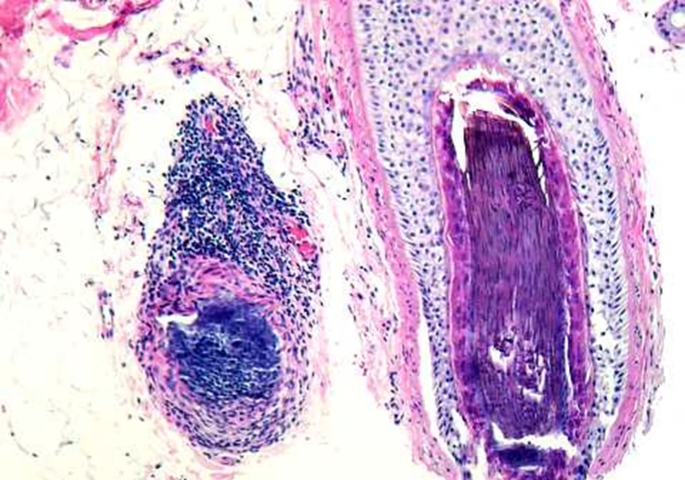 แพทย์ผิวหนัง ไขข้อข้องใจ  “ฉีดวัคซีนโควิด-19 ผมร่วง” จริงหรือ?