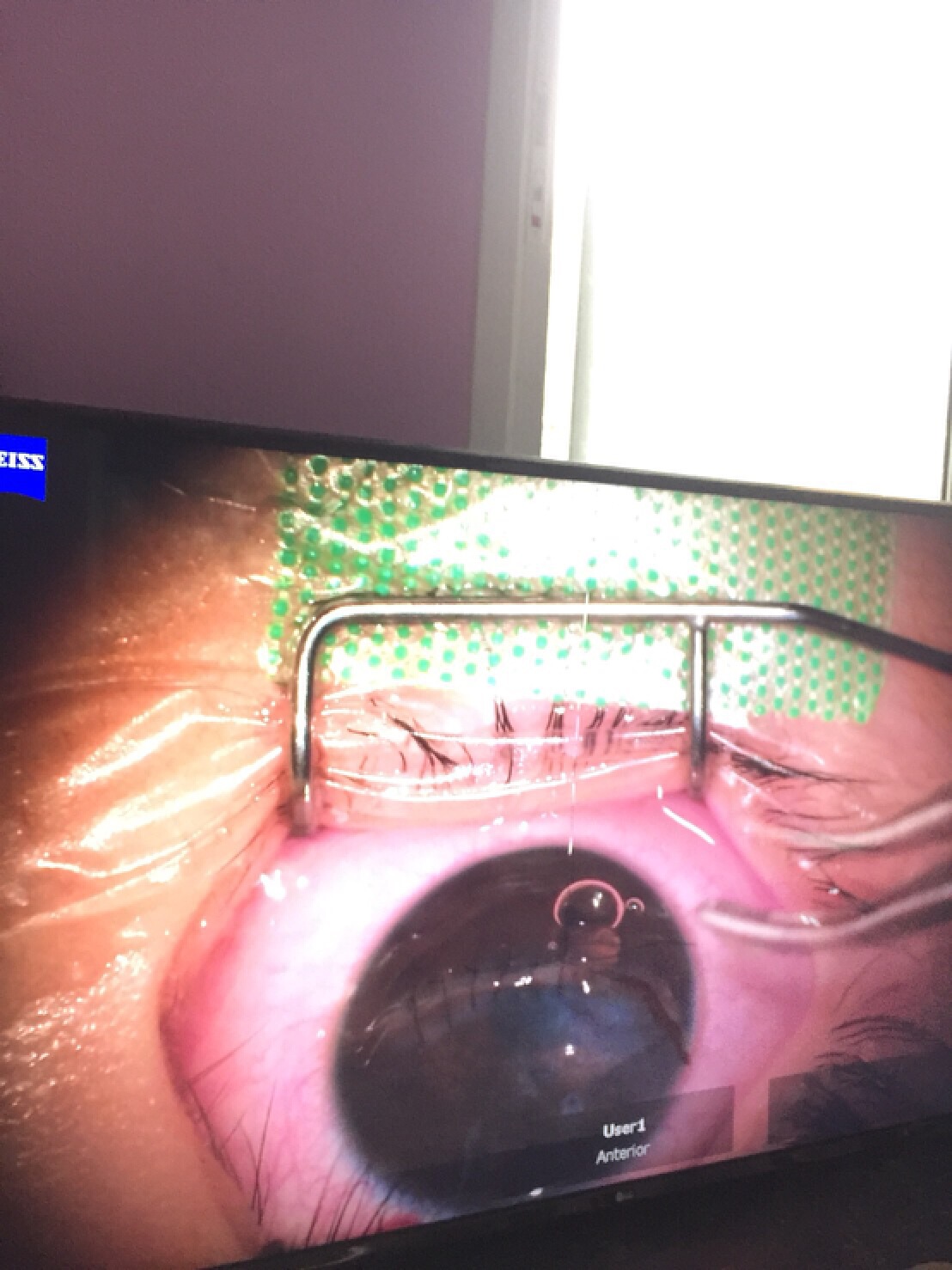 พ่อร้องศูนย์ดำรงธรรม ลูกสาวถูก นร. ใช้ดินสอแทงตาเย็บ 13 เข็ม