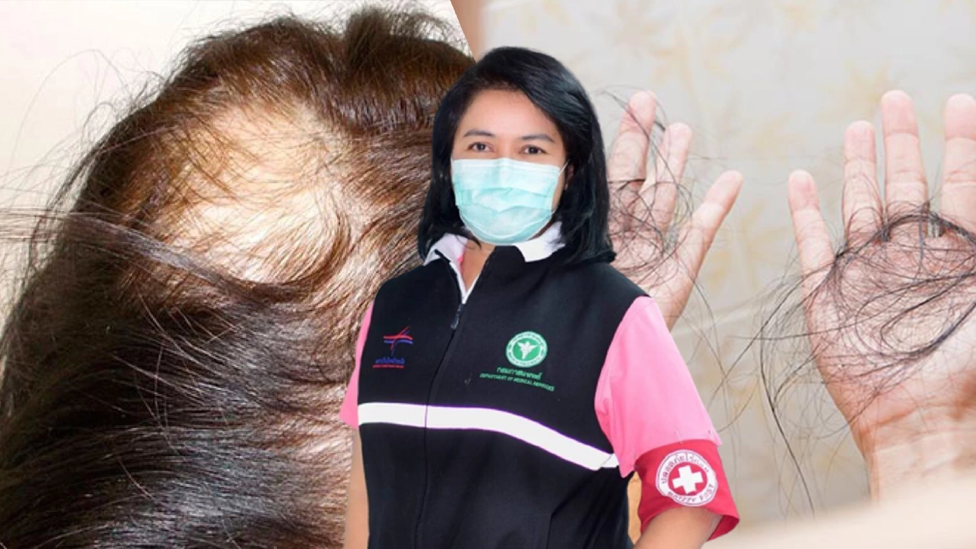 แพทย์ชี้ “ภาวะผมร่วงเป็นหย่อม” เกิดได้หลังฉีดวัคซีนโควิด 19