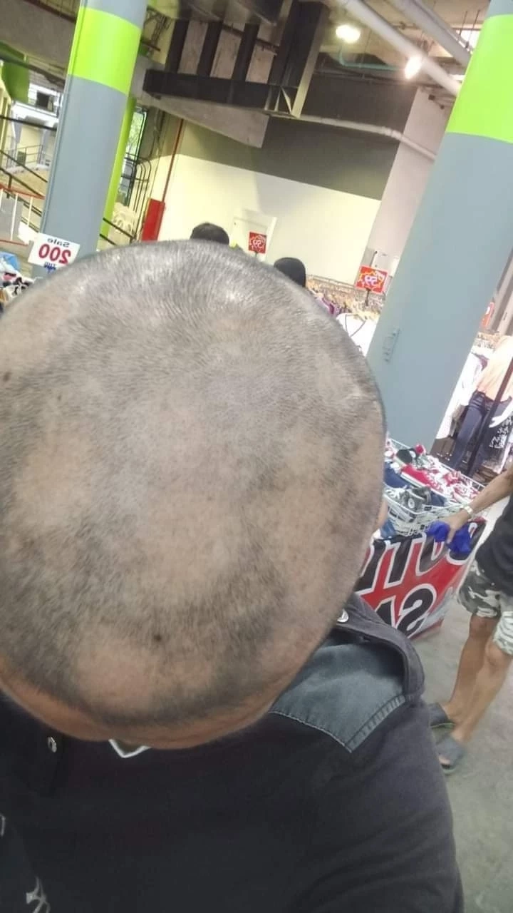 โผล่อีกเพียบ! ฉีดวัคซีนแล้วผมร่วง หวังหน่วยงานรัฐช่วยเหลือ