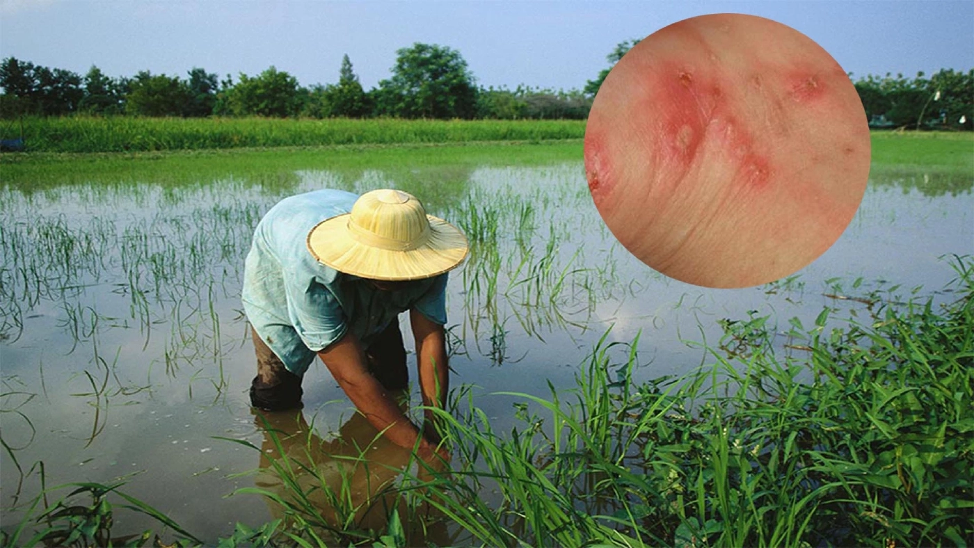 กรมควบคุมโรคเตือน ช่วงนี้ระวังป่วย "โรคเมลิออยโดสิส"