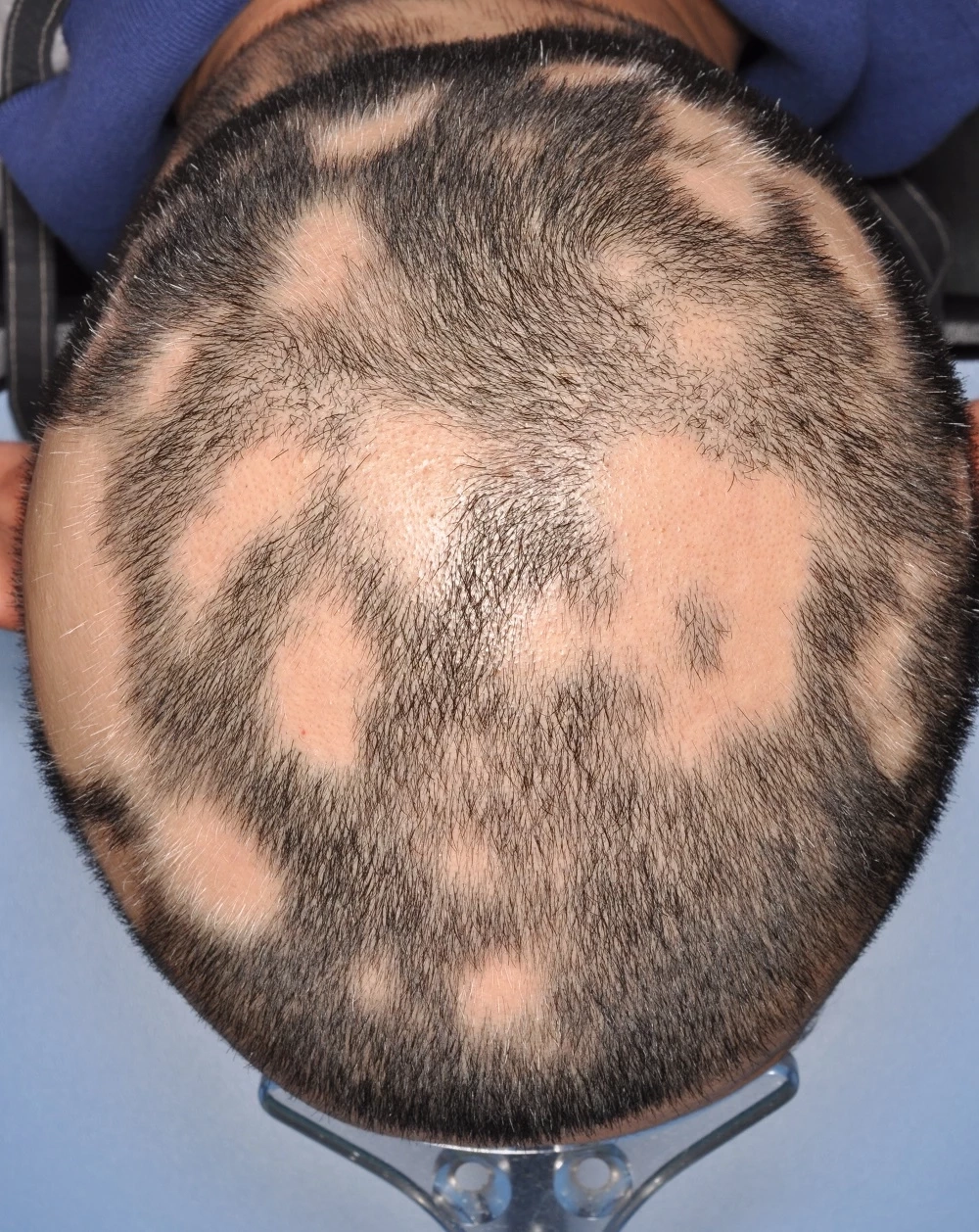 แพทย์ผิวหนัง ไขข้อข้องใจ  “ฉีดวัคซีนโควิด-19 ผมร่วง” จริงหรือ?