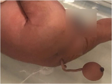 ช็อกโลก ‘ทารกน้อยบราซิล’ คลอดออกมาพร้อมหางยาวประมาณ 12 ซม.