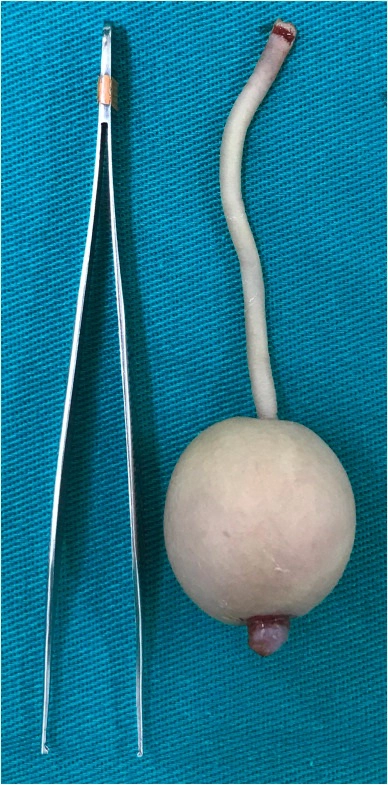 ช็อกโลก ‘ทารกน้อยบราซิล’ คลอดออกมาพร้อมหางยาวประมาณ 12 ซม.