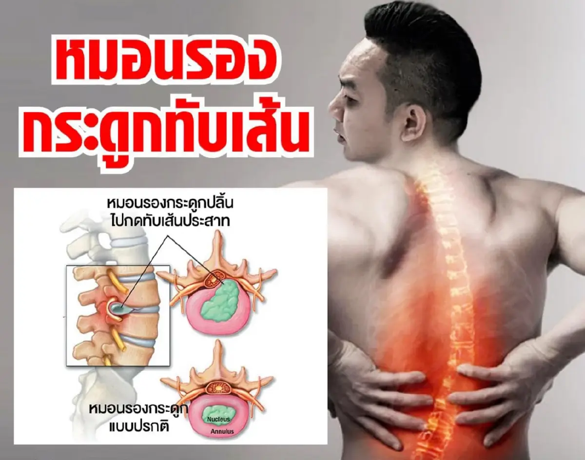 หมอนรองกระดูกทับเส้น  ไม่ควรนิ่งนอนใจ อาจกลายเป็นอัมพาตได้