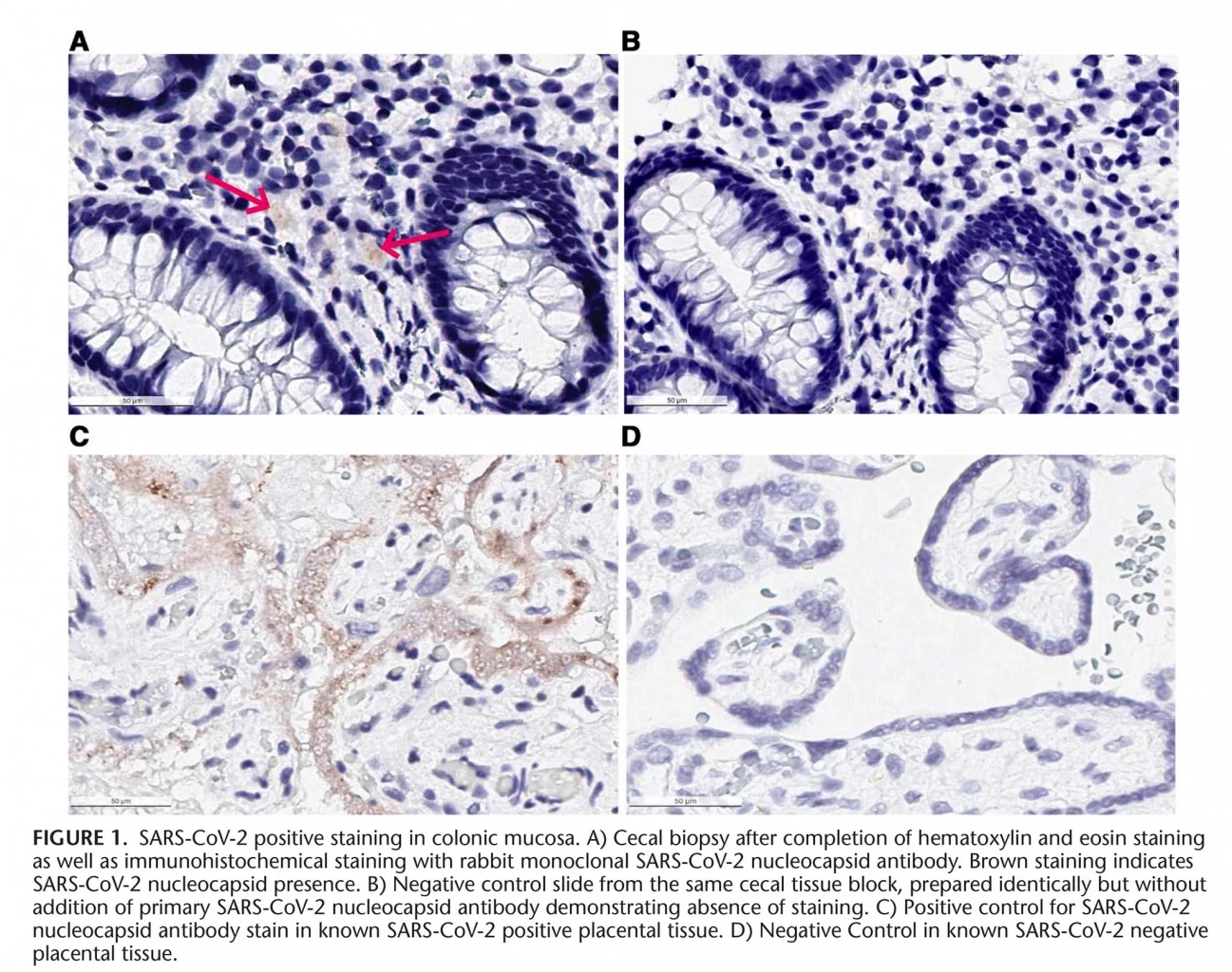 หมอธีระ เผยพบอาการ Long COVID ในผู้หญิงมากกว่าชาย