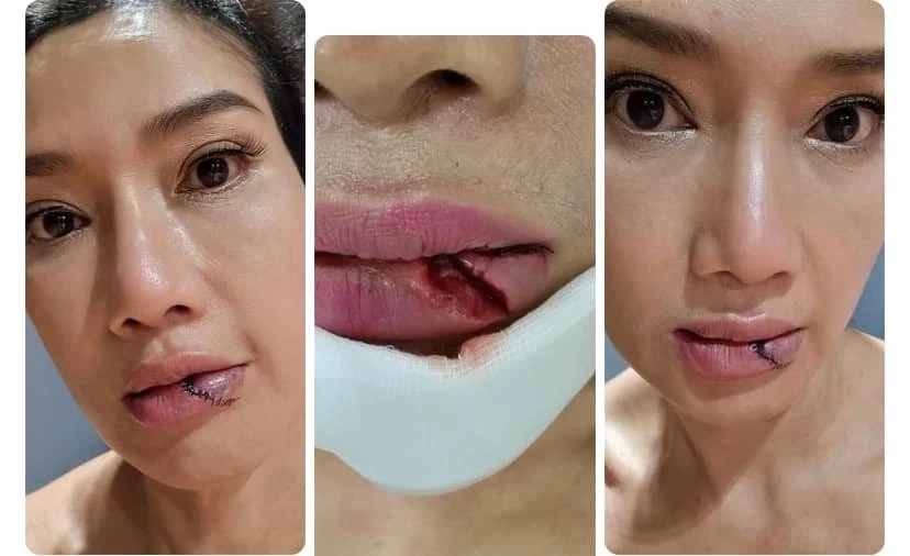 ส่งกำลังใจ  “ดี้ ชนานา” หวิดเสียโฉม ประสบอุบัติเหตุ รถไถลเข้าชนเสาไฟฟ้า