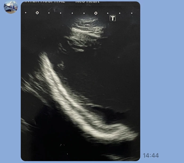 หมอยงเผย การเกิดกล้ามเนื้อหัวใจอักเสบ หลังฉีดวัคซีน mRNA ในวัยรุ่น