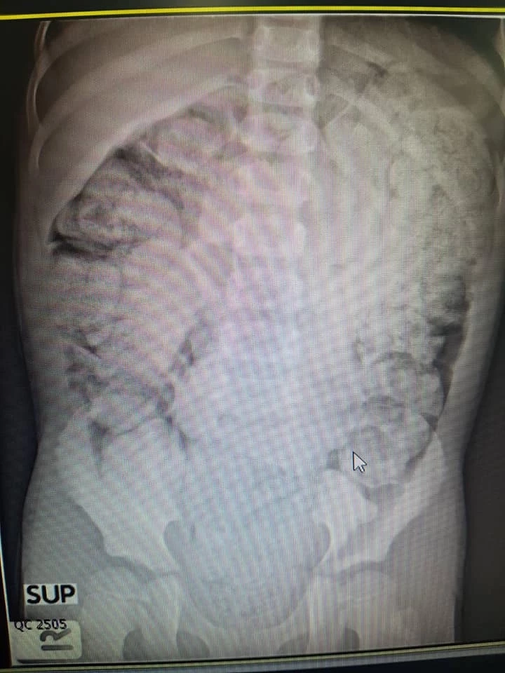 เช็กด่วน! โรคขี้เต็มท้อง ชาวเน็ตฮือฮาแห่สำรวจตัวเอง หมอชี้สุดอันตราย