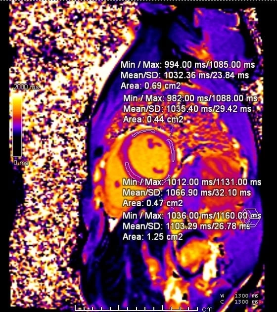 หมอยงเผย การเกิดกล้ามเนื้อหัวใจอักเสบ หลังฉีดวัคซีน mRNA ในวัยรุ่น