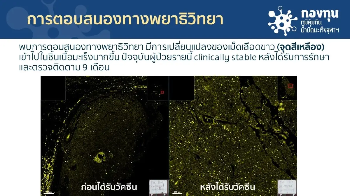 ความคืบหน้า “วัคซีนรักษามะเร็งเฉพาะบุคคล”  มีผลข้างเคียงน้อย