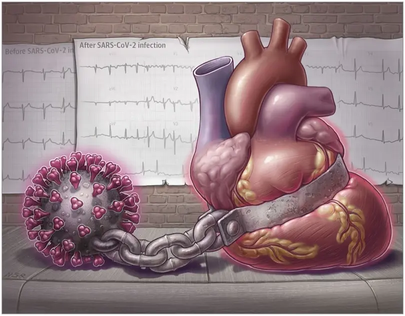 นพ.ธีระ เผย ผู้เคยติดโควิด ระยะยาว เสี่ยงมีภาวะโรคหัวใจ หรือ COVID Heart