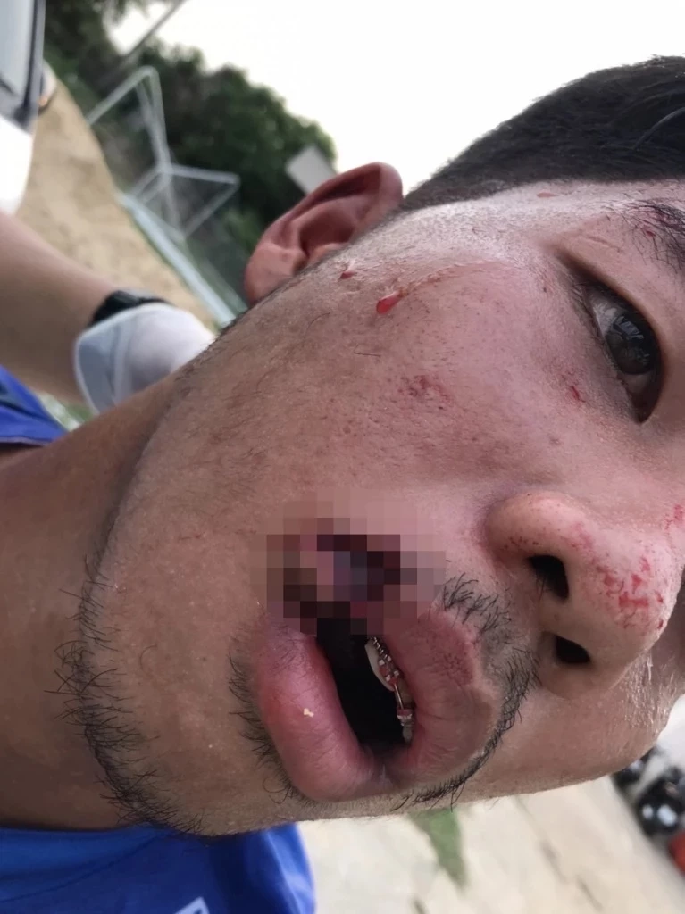 นอร์ทกรุงเทพ แถลง อาการล่าสุด ศุภสัณฑ์ เหยื่อศอกไร้น้ำใจ อิศเรศ น้อยใจบุญ