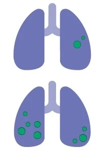 จับสัญญาณ "มะเร็งปอด" โรคร้ายที่คร่าชีวิต "ครูมืด" และคนดังไปมากมาย