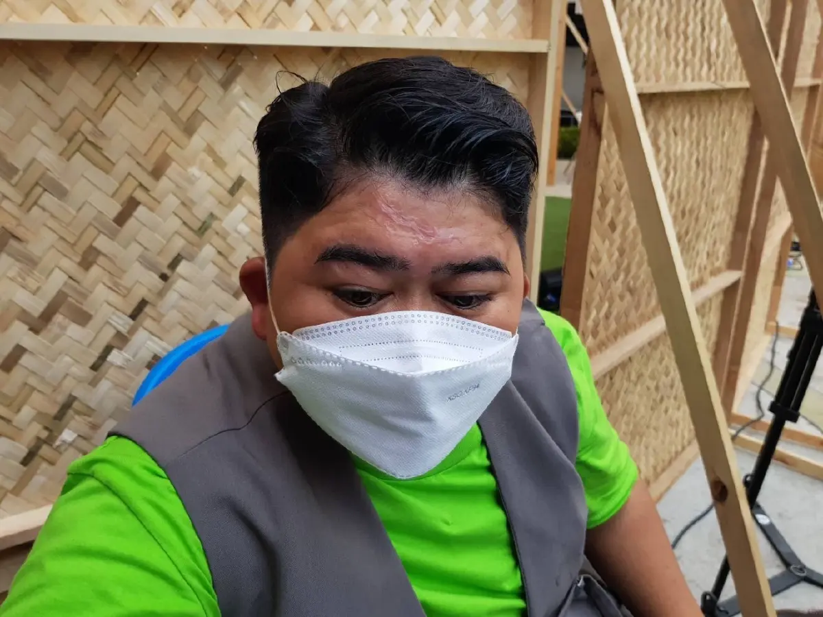“โก๊ะตี๋” เกิดอุบัติเหตุหวิดเสียโฉม ลั่น!!เรื่องนี้ตัวเองเป็นต้นเหตุ