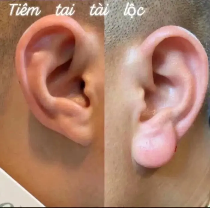 ฉีดฟิลเลอร์ใส่หู อีกเทรนด์ศัลยกรรมแนวใหม่ โดยทำการปั้นติ่งหูให้กลมเหมือนพระสังกัจจายน์