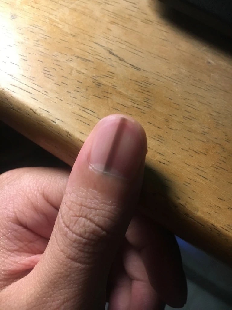 แพทย์เตือนอย่าประมาท "ขีดบนเล็บ" อาจเป็นสัญญาณเตือน "มะเร็งผิวหนัง"