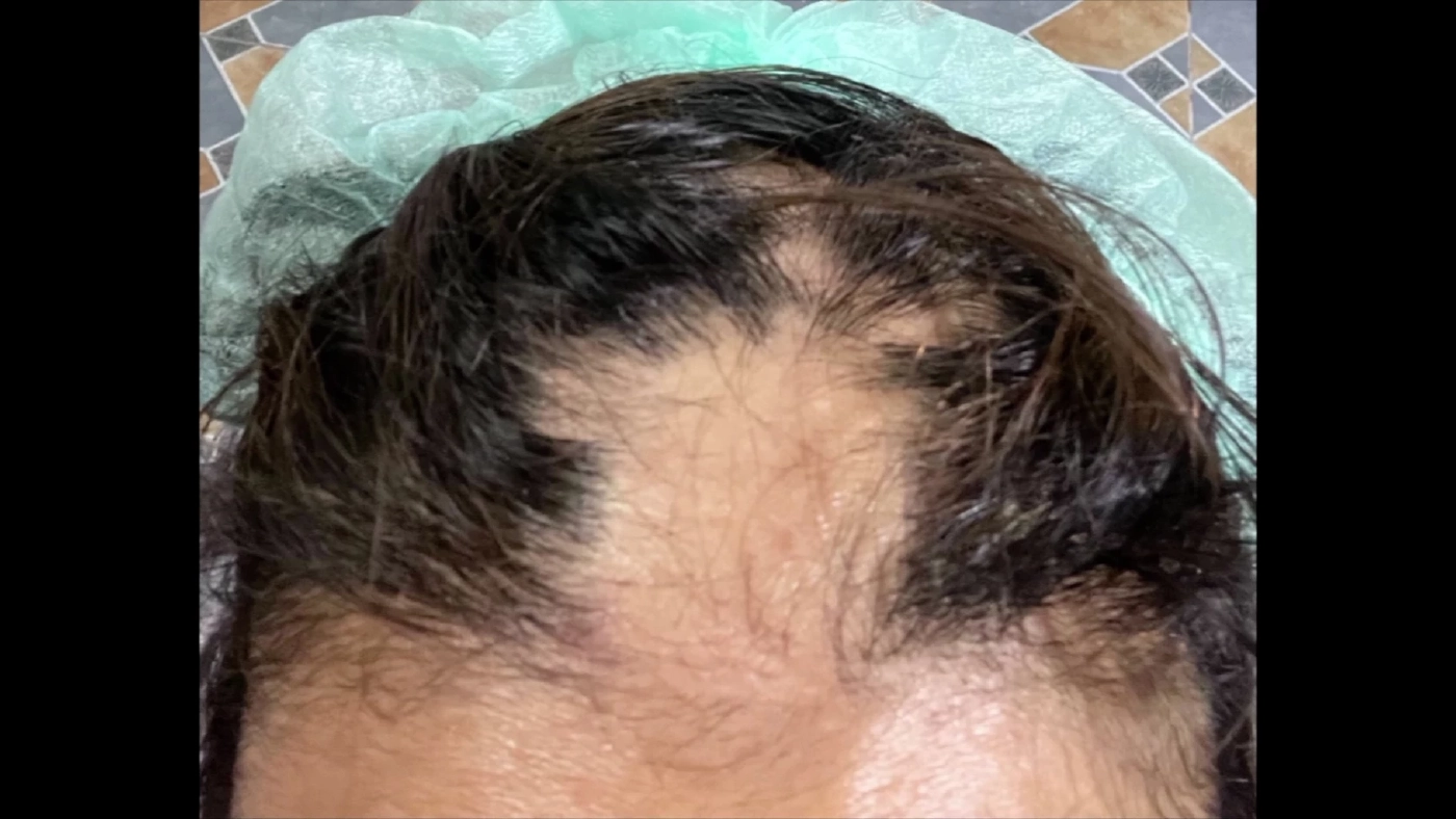 สาวร้อง!ยืดผมร้านเสริมสวย สุดท้ายผมร่วงทั้งศีรษะ