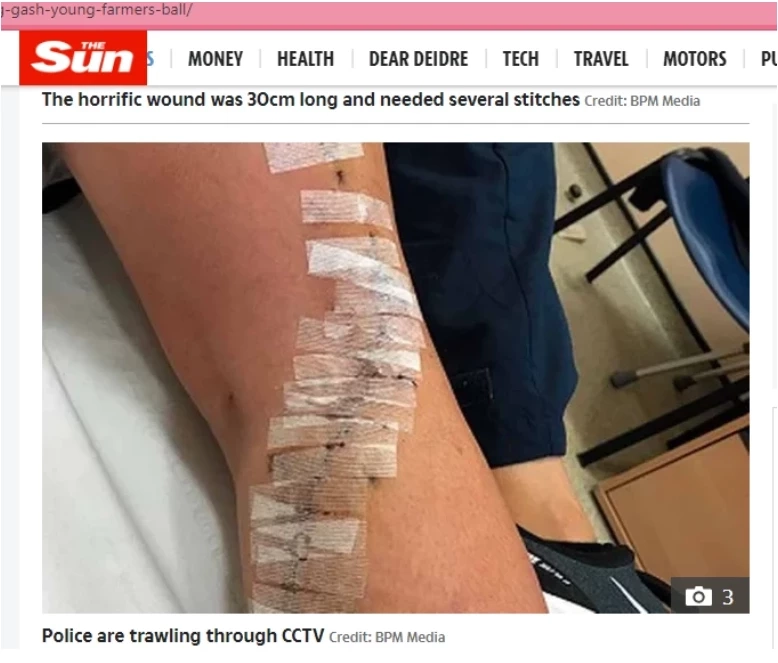 ภาพต้นทางที่ ตร.นำมาแถลงประกอบเทียบเคียงรอยแผลที่ขาของ "แตงโม นิดา"