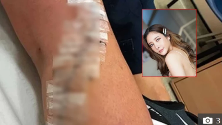 ภาพบาดแผลที่ ตร. นำมาเทียบบาดแผลที่ขาดาราสาว "แตงโม นิดา"