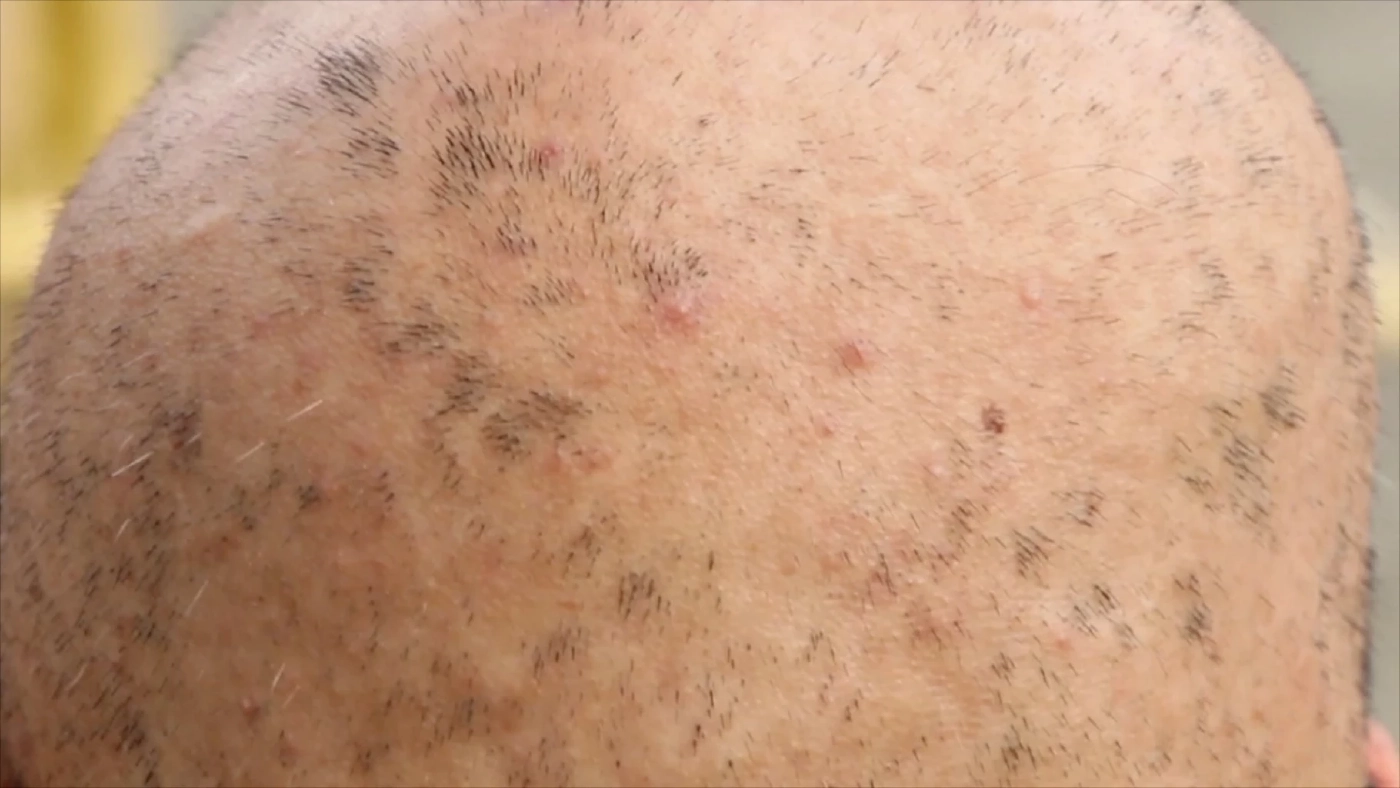 สาวร้อง!ยืดผมร้านเสริมสวย สุดท้ายผมร่วงทั้งศีรษะ