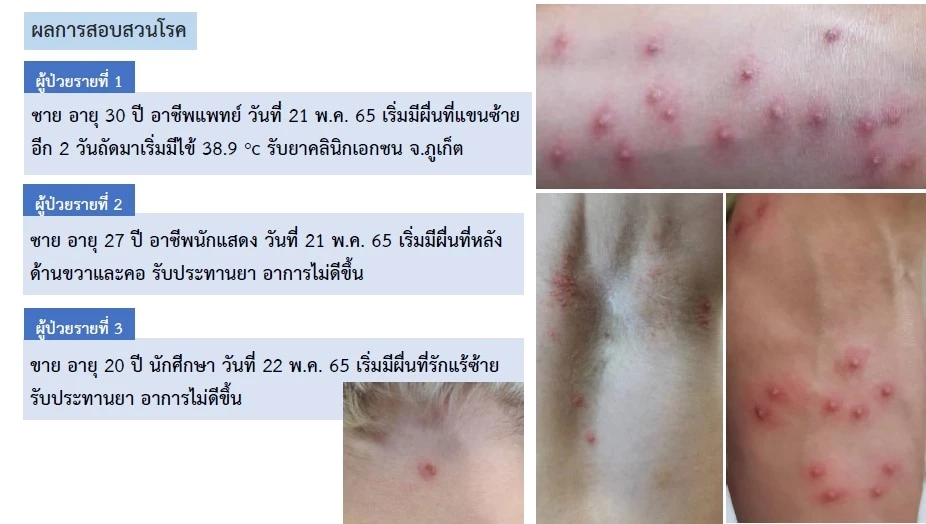 ผวา!! สธ.ไทยติดตามผู้สัมผัสใกล้ชิด "ฝีดาษลิง” 12 ราย พบมาต่อเครื่องที่ไทย