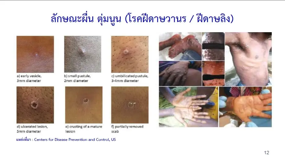 อภ.แช่แข็ง “วัคซีนฝีดาษ” 43 ปี นับหมื่นโดส กรมวิทย์ฯเร่งตรวจสอบประสิทธิภาพ