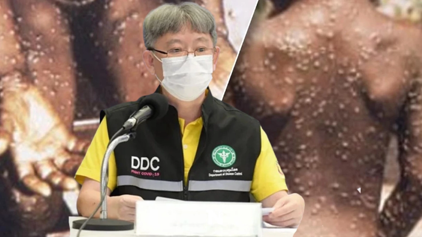 เเนะ 5 วิธีง่ายๆ ป้องกันตนเองและครอบครัว ให้ห่างไกลจาก “โรคฝีดาษลิง”